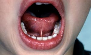 Пластика уздечки губ и языка: почему оперировать важно?