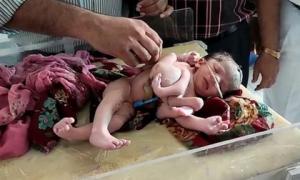 В Індії народилася 
дівчинка з чотирма ногами і трьома руками 