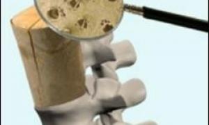 Хіміки розробили штучні кістки з дерева