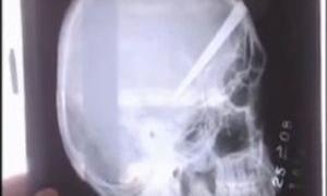 Бразилієць жив з лезом ножа в голові протягом трьох років