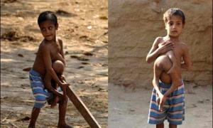 Індійського хлопчика з чотирма ногами вважали Шивою