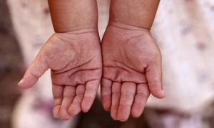 Пальці вкажуть на схильність до певних недуг