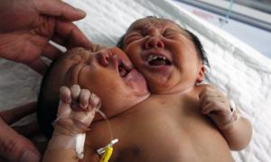 Китаянка народила двоголову дитину