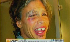 Стів Тайлер показав розбиту у ванній фізіономію