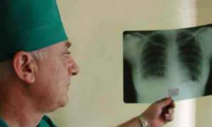 Лікарі-фтизіатри нагадують, що туберкульоз має прихований перебіг