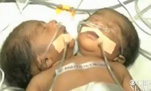 В Індії медики борються за життя двоголового малюка