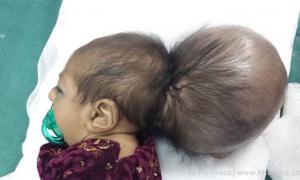 В Афганістані лікарі провели унікальну операцію й відрізали дитині другу голову