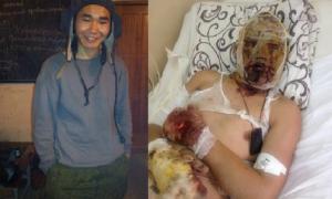 Бурятський найманець, який обгорів на Донбасі, не отримав жодної допомоги від Росії