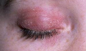 Примочки допоможуть позбутись алергії на очах