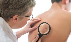 Рак шкіри частіше загрожує рудоволосим людям