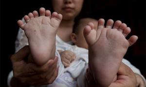 У китайській родині народився хлопчик з 31 пальцем (фото)
