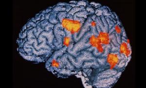 Людський мозок здатний самостійно виліковуватися від шизофренії
