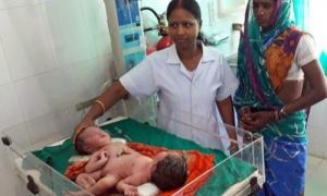 В Індії народилися різностатеві сіамські близнюки (фото)
