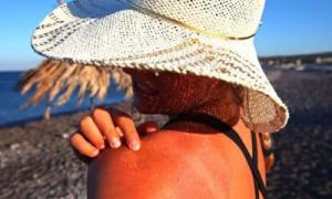 19-річна росіянка на пляжі отримала опіки 90% шкіри
