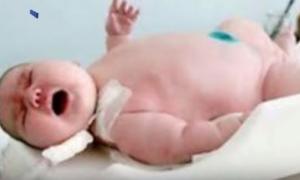 В Австралії 272-кілограмова жінка народила 18-кілограмову дитину (відео)

