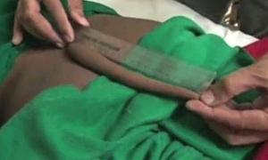 18-річному індійцеві хірурги видалили хвоста, який вважався "символом благополуччя" (фото)