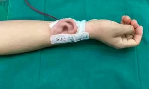 Китайські медики для трансплантації виростили вухо на руці пацієнта 