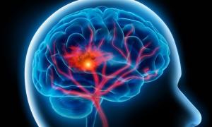 Учені розробили нову методику лікування набряку мозку 

