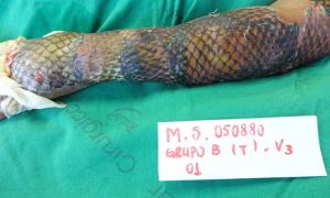 У Бразилії медики для лікування опіків застосували риб’ячу шкіру
