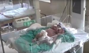 В Індії народилася двоголова дитина з трьома руками (відео)