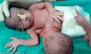 В Індії народилася дівчинка з другою головою, що росте з живота та третьою рукою