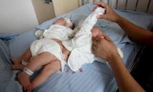 В Китаї лікарі успішно провели операцію з розділення сіамських близнюків