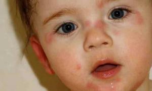 Діти з алергією частіше за інших мають розлади психіки