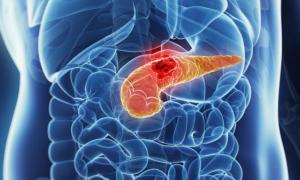 Знайдено гени, що допомагають вижити при раку підшлункової залози