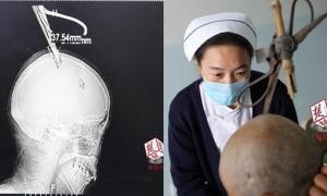 Китаянка з ножицями в голові доїхала до лікарні на автобусі і вижила