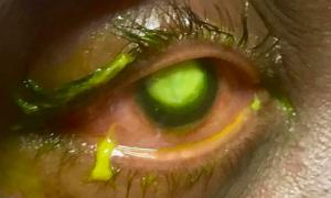 Бактерії, що пожирають очі,  розплодилися через не зняту на ніч контактну лінзу