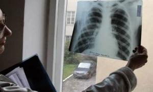На Черкащині зафіксовано першу смерть від свинячого грипу