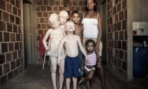 У родині темношкірих бразильців народилося троє альбіносів