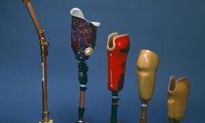 Британець вийшов з лікарні на двох лівих ногах