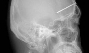 Китаєць, розраховуючи на страхування, забив дружині цвях у голову