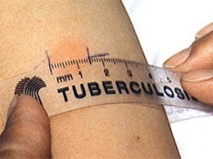 Рівень смертності від туберкульозу на Волині зменшився на 30%
